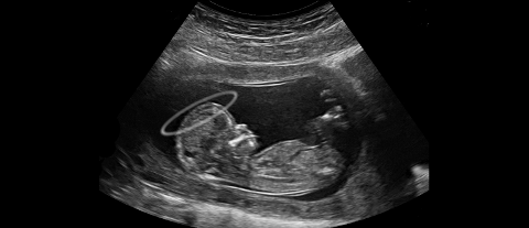 Ultraschallbild von einem Baby mit Heiligenschein